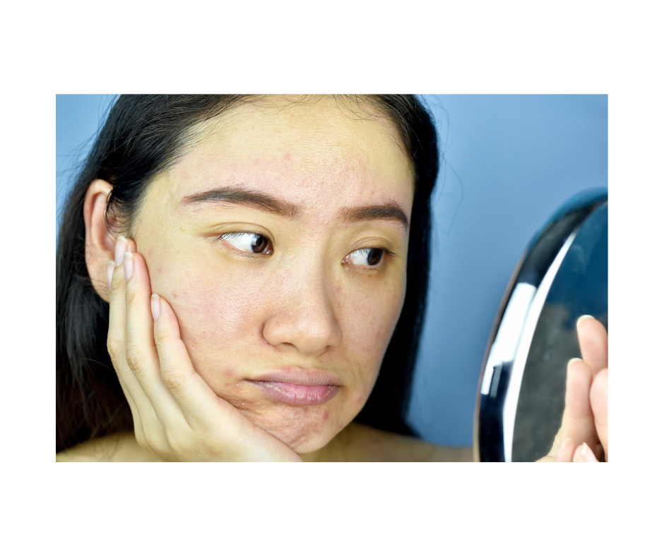 how to minimize large pores